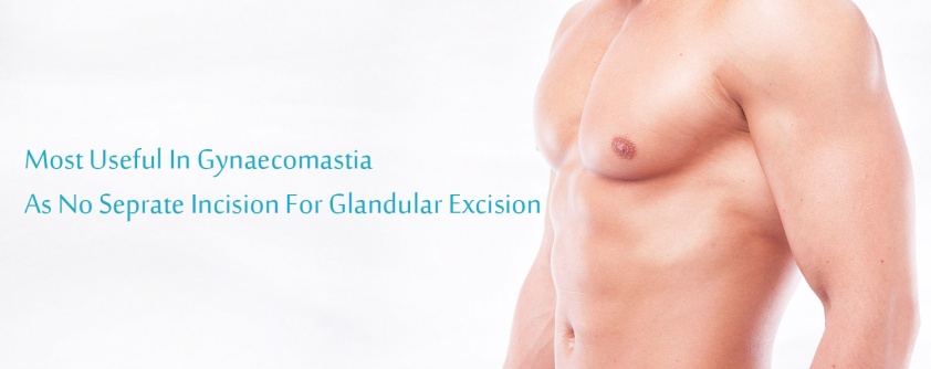 gynaecomastia-gladular-excision